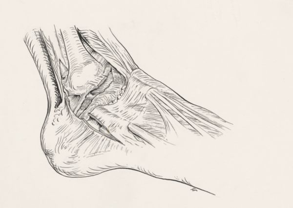 J Tinkelenberg, Torn ankle ligament