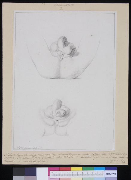 M Houtman, Deformed pubic area in a girl