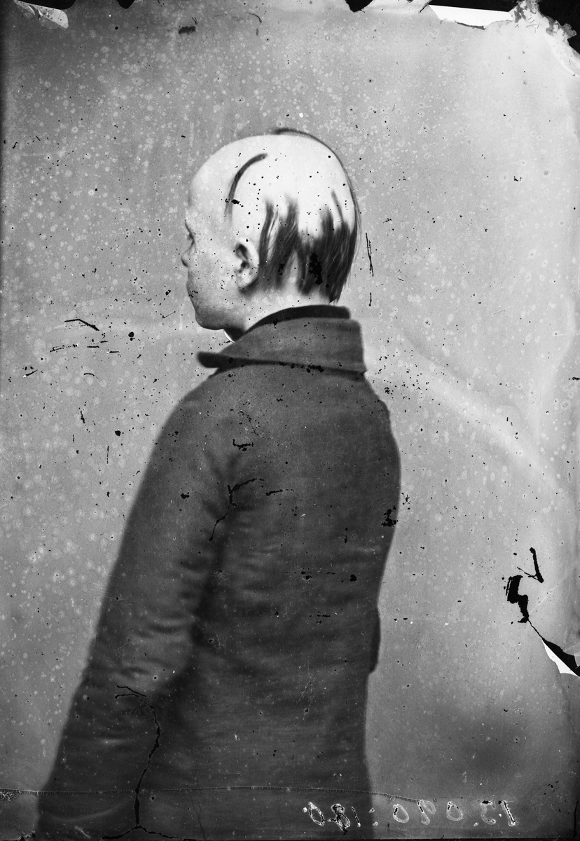 Carl Curman, Man med håravfall.
