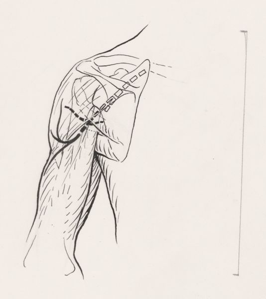 J Tinkelenberg, Circulatory system of the upper arm and shoulder