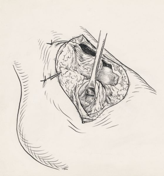 J Tinkelenberg, Surgery of the ankle ligament