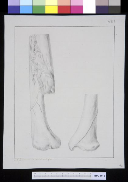 M Houtman, Infected bone