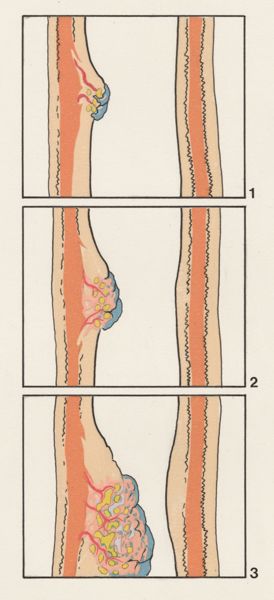 J Tinkelenberg, Part of the heart and circulatory system