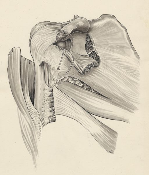 J Tinkelenberg, Damage of the pelvic bones