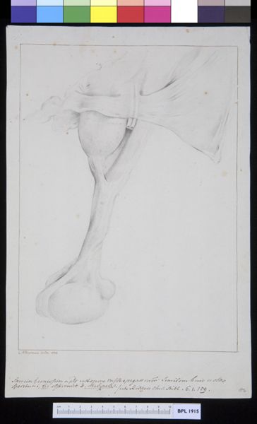 M Houtman, Inguinal hernia