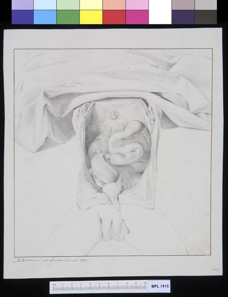 M Houtman, Hernia