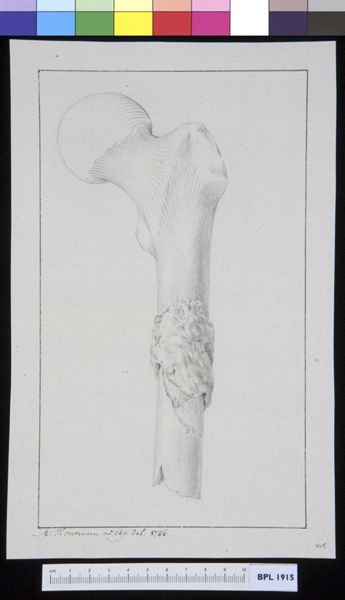 M Houtman, Infected bone (femur)