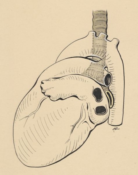 J Tinkelenberg, Heart