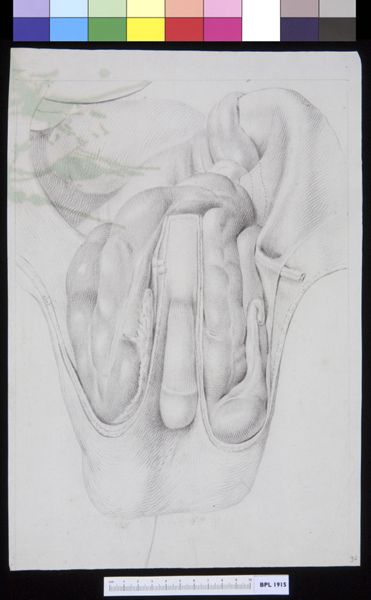 M. Houtman, Inguinal hernia