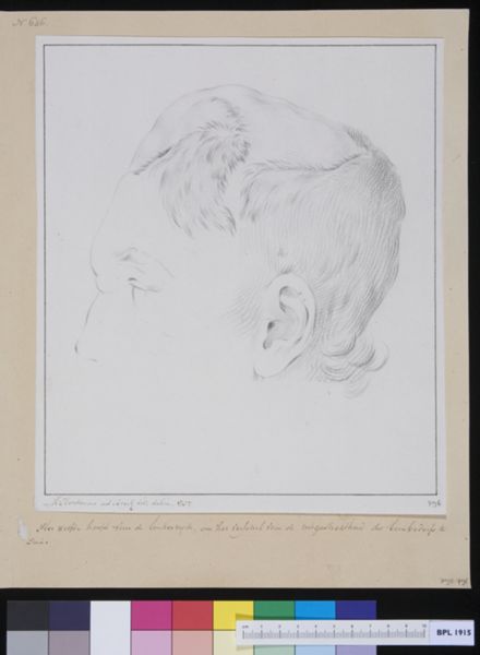 M. Houtman, Ms Cornelis Bardue, a patient suffering from loss of bone structure