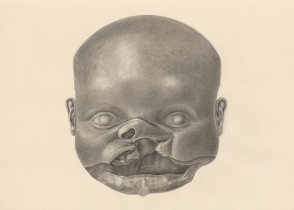 H.G Wetselaar, Deformed fetal head