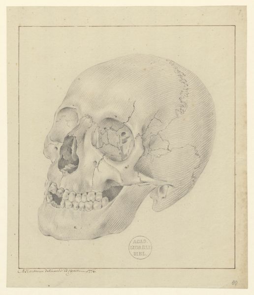 M Houtman, Pathology, fractures (Fractured skull)