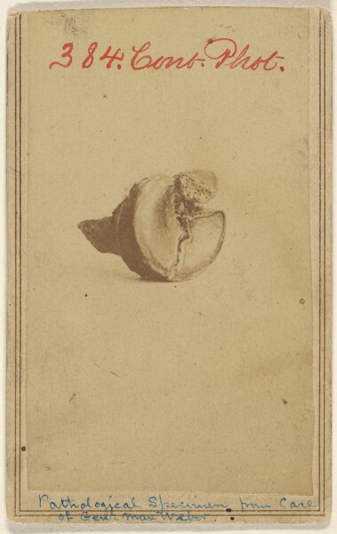 Unknown, Pathological Specimen from case of Genl. Max Weber. [Civil War victim]