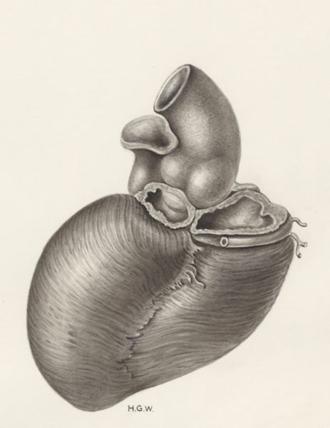 H.G Wetselaar, Heart