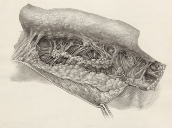 J Tinkelenberg, Muscular tissue of the hand or fingers