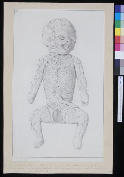 M Houtman, Infant with perforated skin