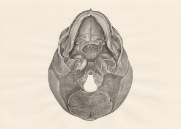H.G Wetselaar, Deformed fetal skull, seen from below