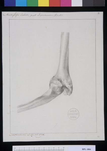 M. Houtman, Pathology, fractures (Ankylosis)