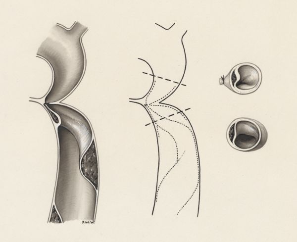 J Wetselaar-Whittaker, Heart surgery