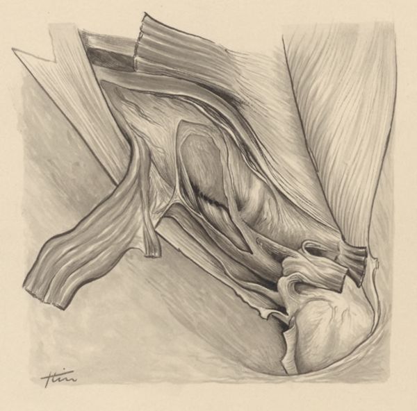 J Tinkelenberg, Tissue of the inguinal