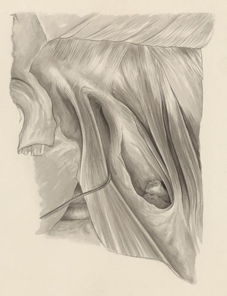 J Tinkelenberg, Tissue of the inguinal