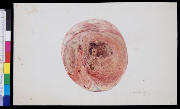 Tiemen Hooiberg, Pathology, heart