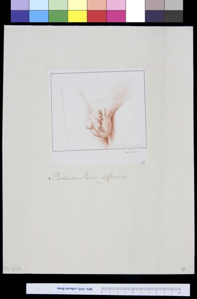 A Bonn, Deformed male genitals