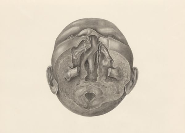 H.G Wetselaar, Deformed fetal head, seen from below
