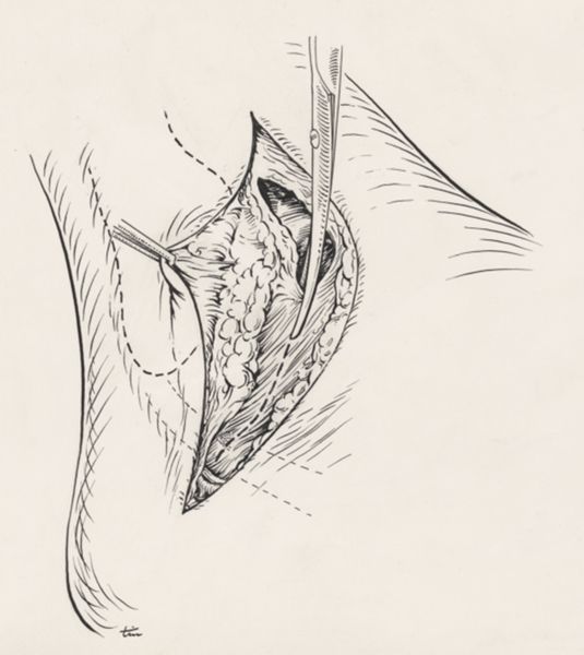 J Tinkelenberg, Surgery of the ankle ligament