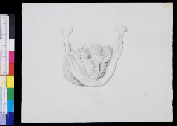 Tiemen Hooiberg, Pathology, skull, lower jaw