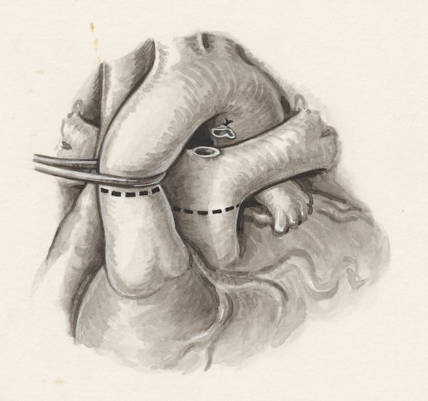 J Wetselaar-Whittaker, Arterial switch surgery