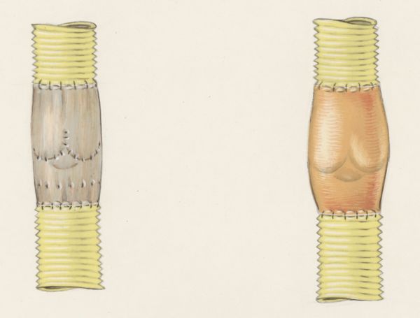 J Tinkelenberg, Thorax surgery