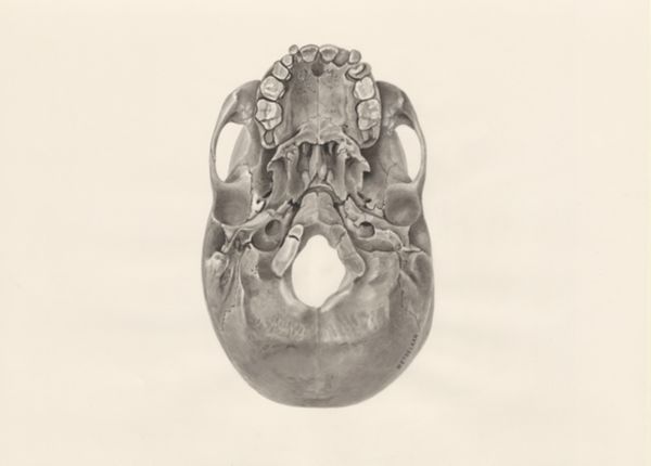 H.G Wetselaar, Deformed fetal skull, seen from below