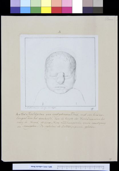 M Houtman, Child with deformed head