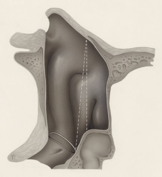 J Tinkelenberg, Respiratory system