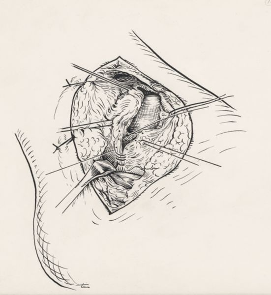 J Tinkelenberg, Surgery of the ankle ligament