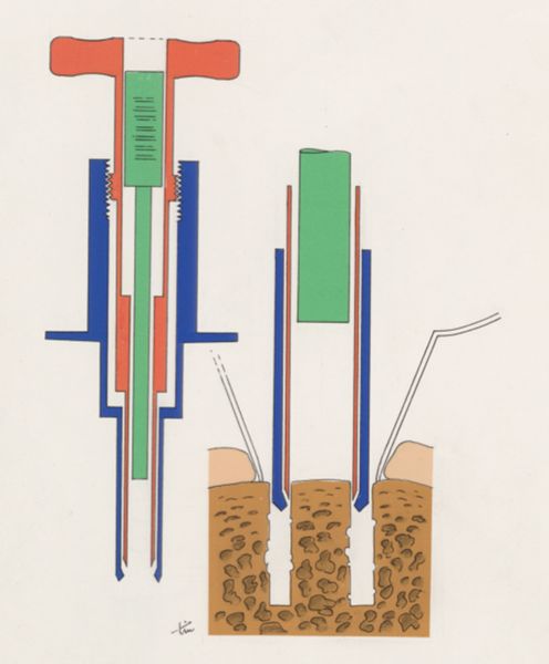 J Tinkelenberg, Bone drilling technique