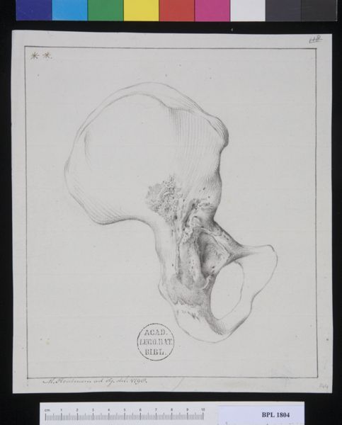 M Houtman, Pathology, fractures (Acetabulum)