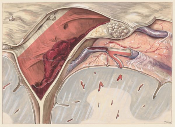 J Wetselaar-Whittaker, Sick human tissue relating to thrombosis