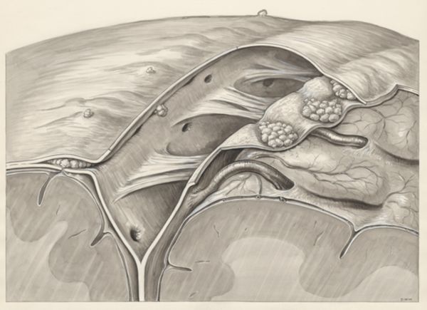 J Wetselaar-Whittaker, Brain tissue