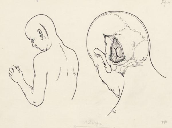 J Tinkelenberg, Neurosurgical Procedures