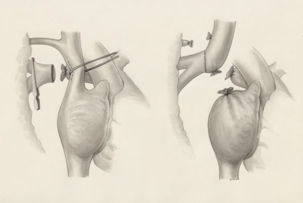J Wetselaar-Whittaker, Heart surgery
