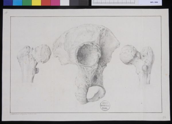 M. Houtman, Pathology, fractures (Femur and hip)