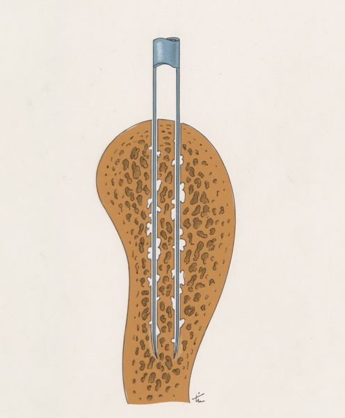 J Tinkelenberg, Bone drilling technique