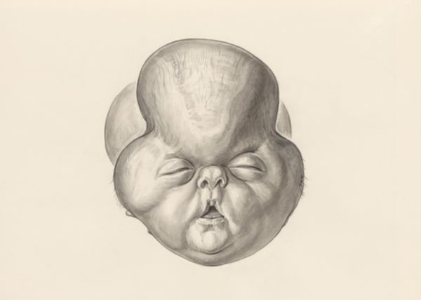 H.G Wetselaar, Deformed fetal head
