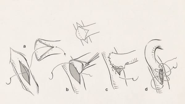 J Tinkelenberg, Thorax surgery