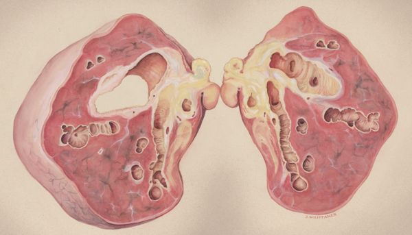 J Wetselaar-Whittaker, Lung tissue