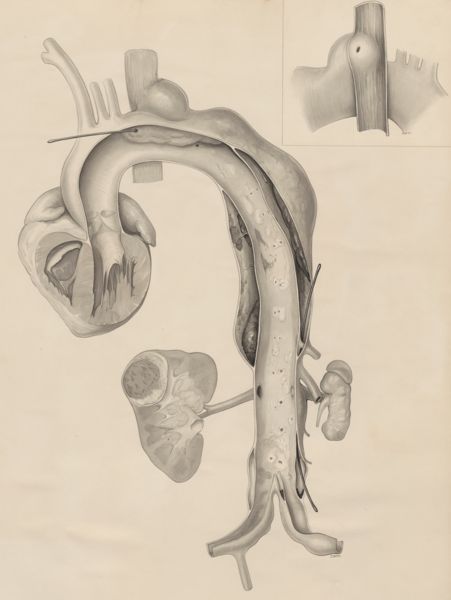 J Wetselaar-Whittaker, Kidneys