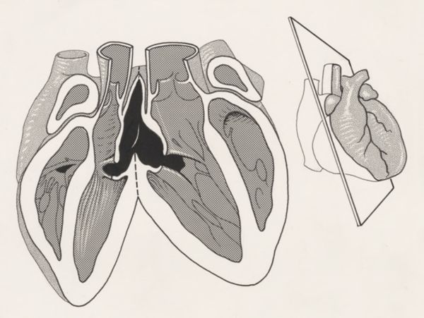 J Tinkelenberg, Heart
