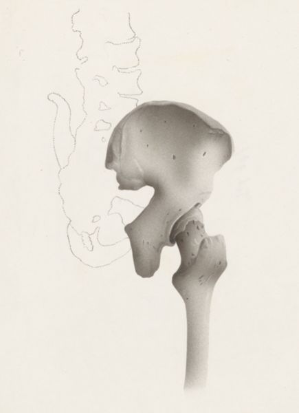 Harry de Bles, Hip joint